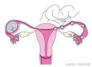 43岁采用供卵试管成功率多少 供卵三代试管移植成功率 异位妊娠（输卵管妊娠